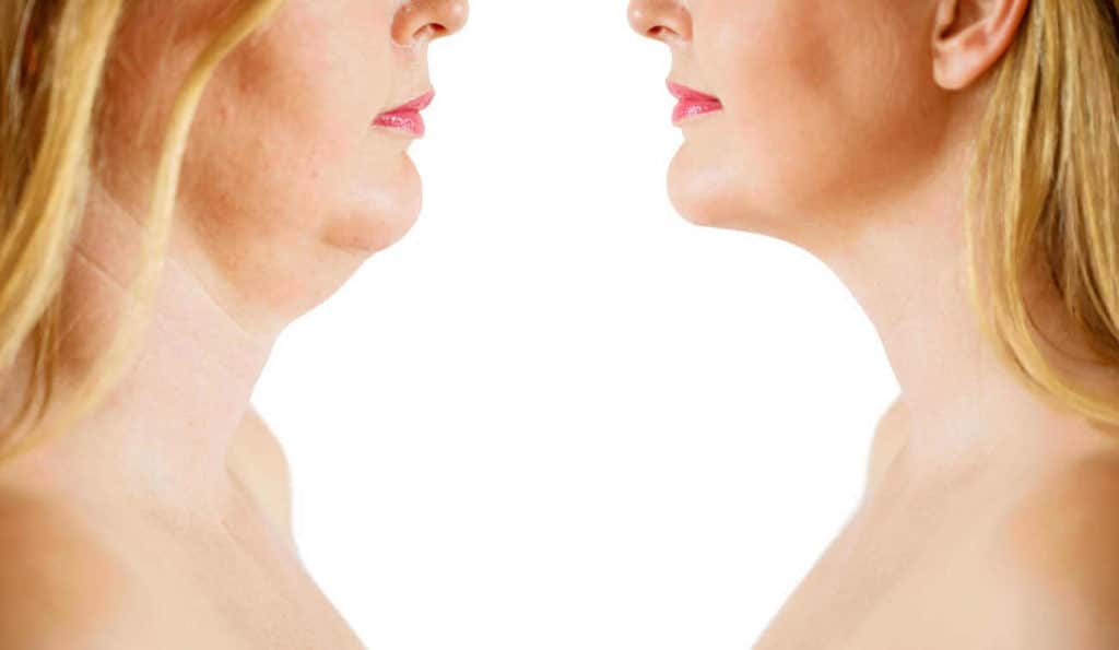 Double Chin treatment Aylesbury before and after results