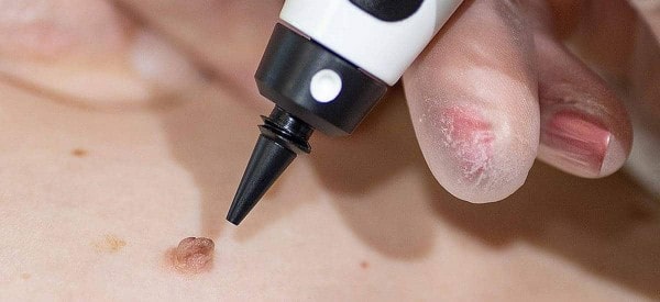 After Skin Tag Removal Aylesbury