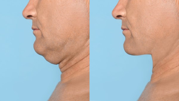 Which Non-Surgical Treatments Work Best for Jowls and Loose Skin Aylesbury?