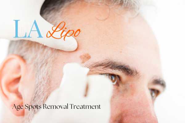What Are the Most Effective Treatments for Age Spots Aylesbury?