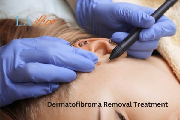 Dermatofibroma Removal Treatment Aylesbury