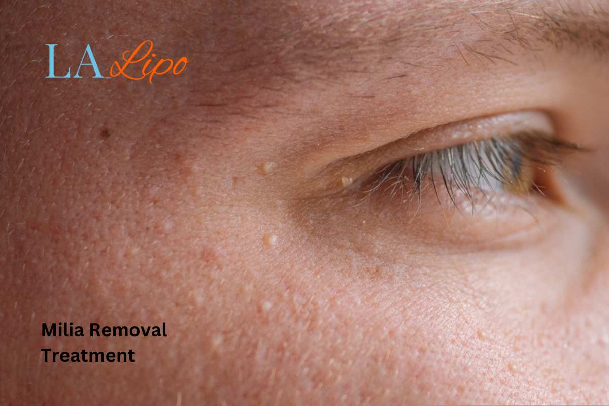 Cryopen Milia Removal: Is It the Easiest and Safest Option Aylesbury?
