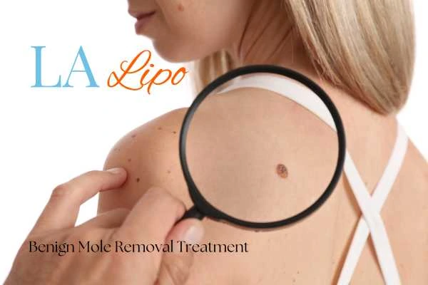 Why getting moles removed Aylesbury can boost your confidence!