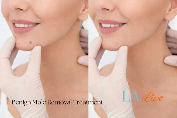 woman's before and after mole removal Aylesbury results