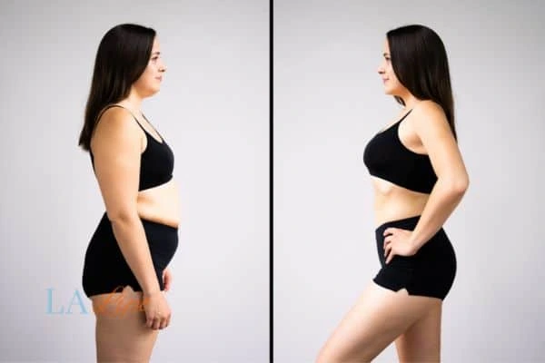 image of woman before and after results of LA-EMS Body Sculpting Aylesbury to help treat Diastasis recti