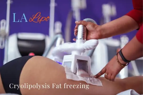 women getting fat freezing Aylesbury
