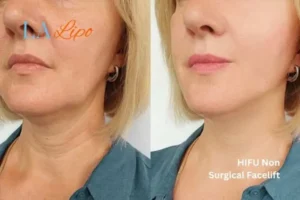 hi-fu for wrinkles Aylesbury before and after results