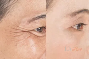 Before and after results of woman - HI-fu wrinkles reduction treatment Aylesbury