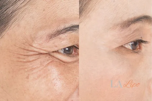 Before and after results of woman - HI-fu wrinkles reduction treatment Aylesbury