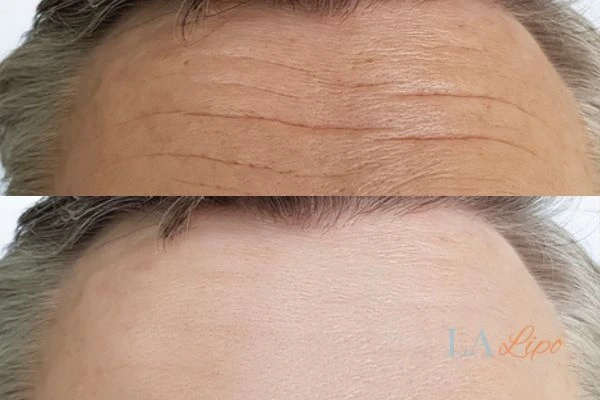 results of HIFU Aylesbury on mans forehead to help reduce lines and wrinkles