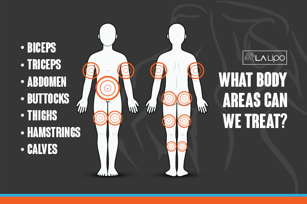 Graphic to show areas you can have LA-EMS Body Sculpting Aylesbury treatment.