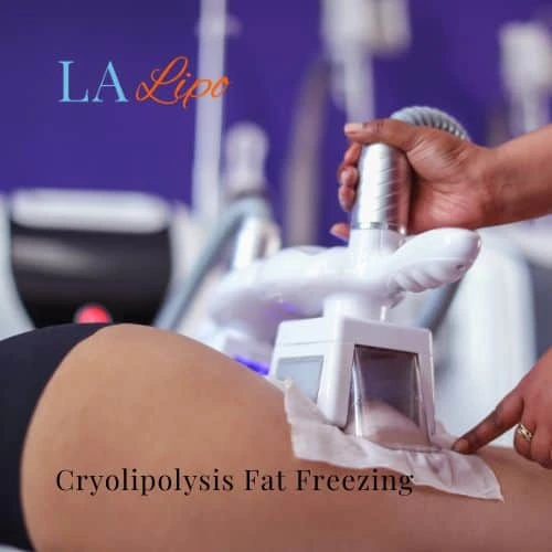 fat freezing - Cryolipolysis Aylesbury