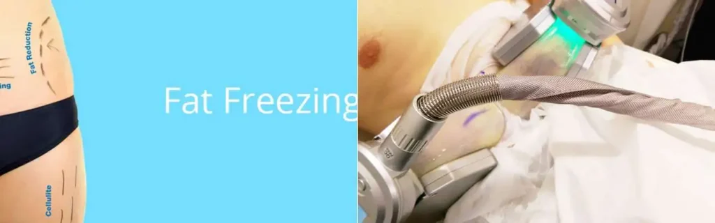 multi areas of a persons body having coolsculpting Aylesbury treatment