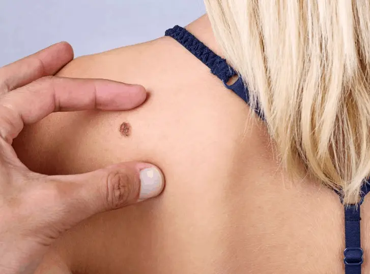 woman having mole removal Aylesbury consultation before treatment.