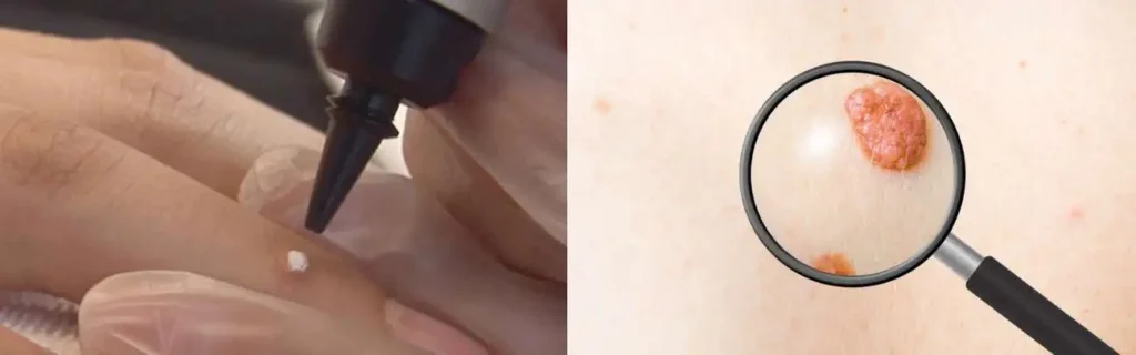 Cryopen for mole removal Aylesbury - speak to our team today!