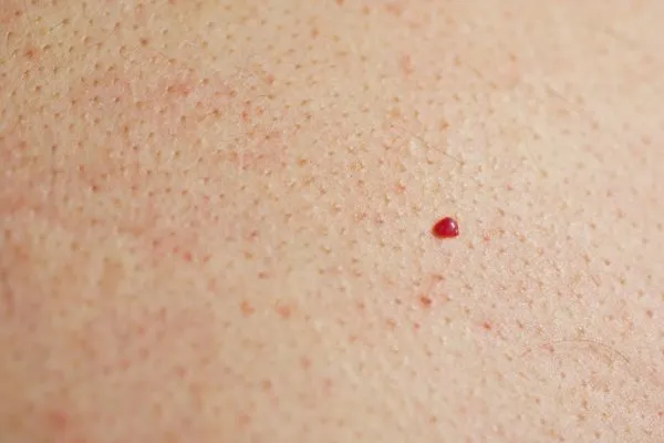 close up of a cherry angioma Aylesbury