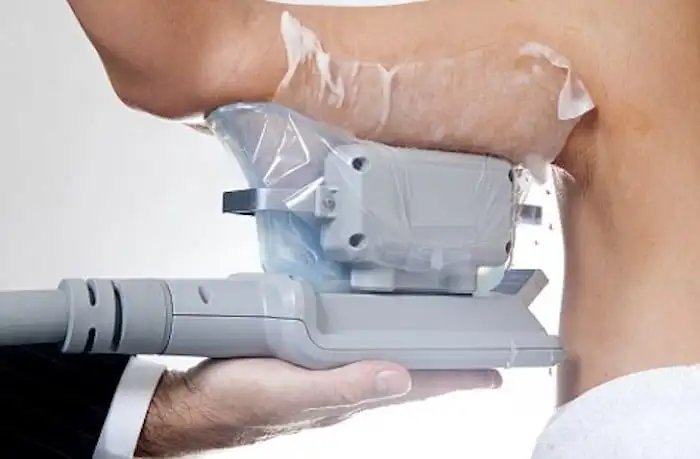 Picture of fat freezing Aylesbury on the upper arms.