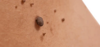 image of a skin tag Aylesbury