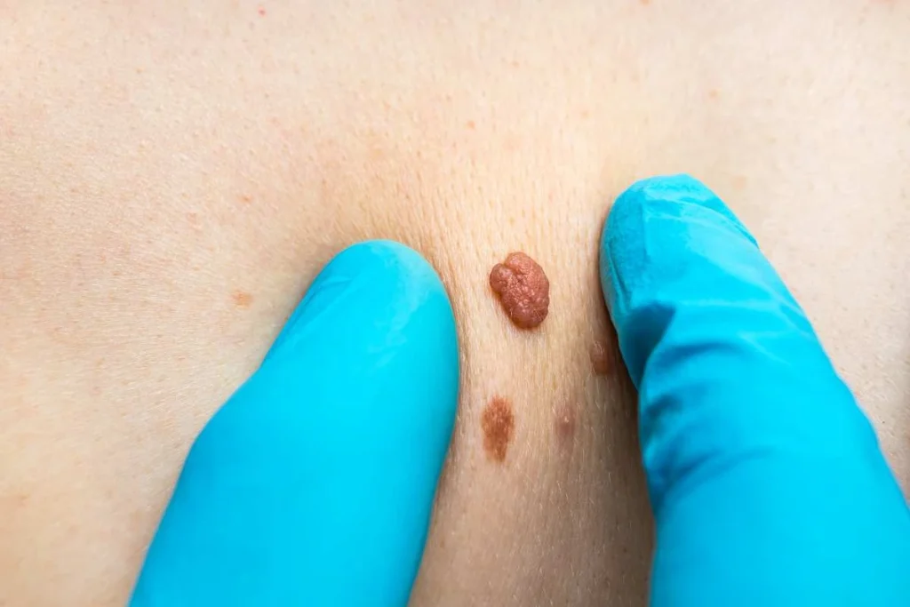 Consultant examining a skin tag Aylesbury