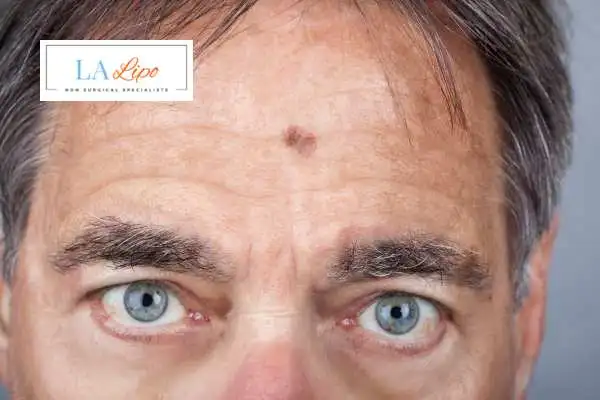 Solar Lentigo Removal Aylesbury image of man with mark on his forehead