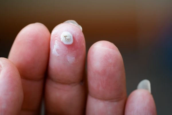 wart on person finger - cryotherapy to treat from LA LIPO Aylesbury
