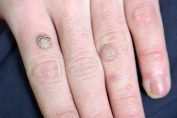 photo of warts on person hand - see wart removal Aylesbury from LA LIPO