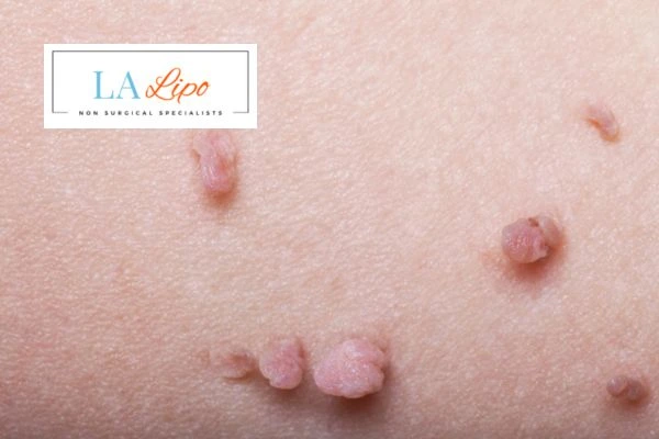 Does cryopen skin tag removal Aylesbury hurt? Find out now call our team today!