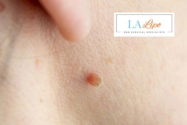 Book skin tag removal Aylesbury today speak to our team now!