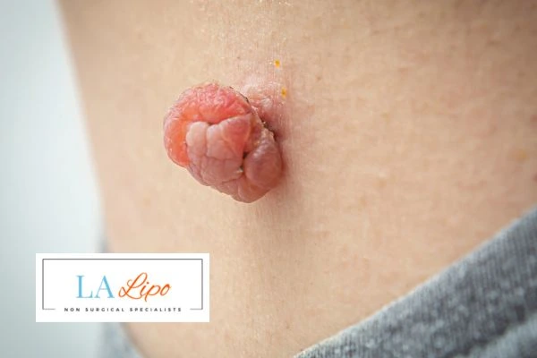 Interested in skin tag removal Aylesbury? Concerned about the pain? Find out more today!