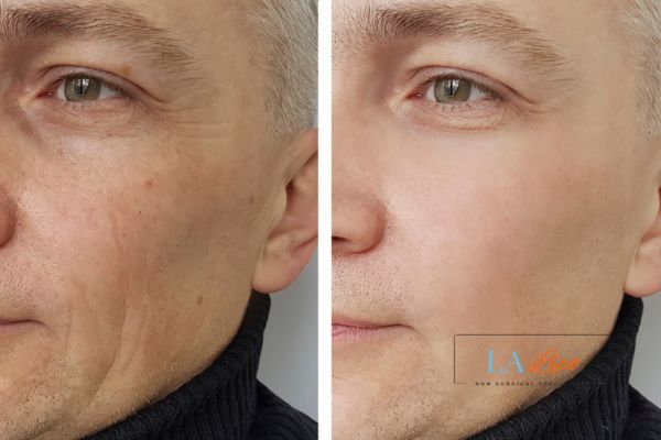 See the amazing results of Morpheus8 Treatment Aylesbury!