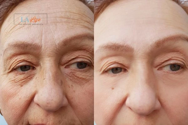 The powerful benefits of Morpheus8 Treatment Aylesbury - Call Our team today!