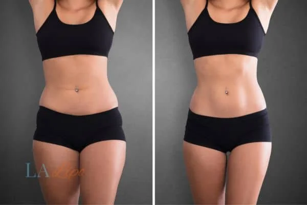 before and after results of non-surgical treatment to help a woman's body image and mental health Aylesbury