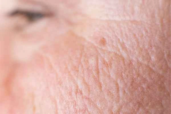 close up picture of a woman's face showing an age spot Aylesbury