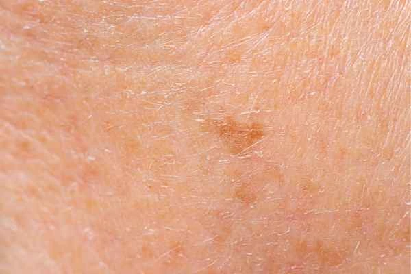 close up picture of age spots Aylesbury