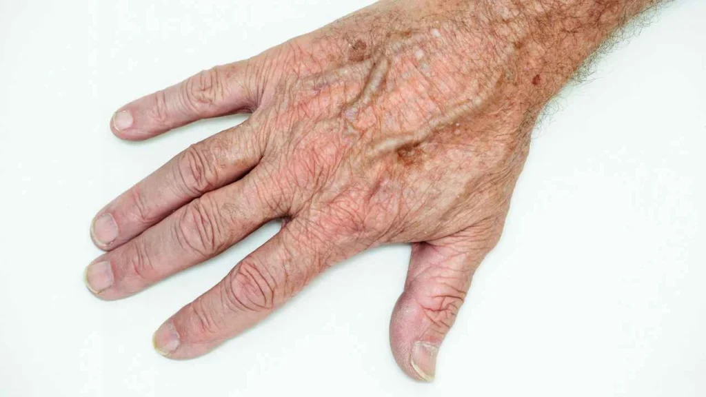 Male hand showing age spot Aylesbury