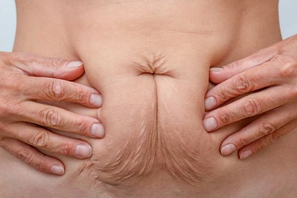 Image of a woman's stomach with loose skin - example of skin tightening Aylesbury options