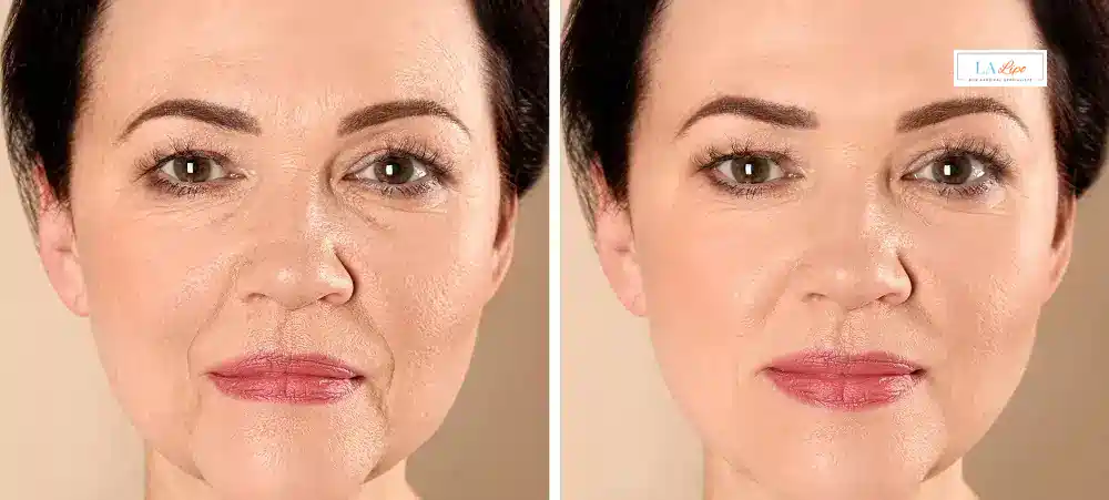 How Long Does It Take to See Results and How Long Do They Last Aylesbury?