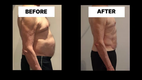 What Symptoms Can Diastasis Recti Cause in Men? Weak Core, Back Pain and Poor Posture Aylesbury